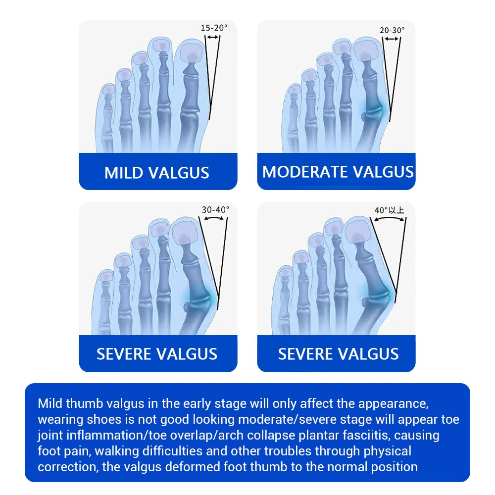 PASTSKY Bunion Corrector Toe Separator Orthotics for Hallux Valgus Relief